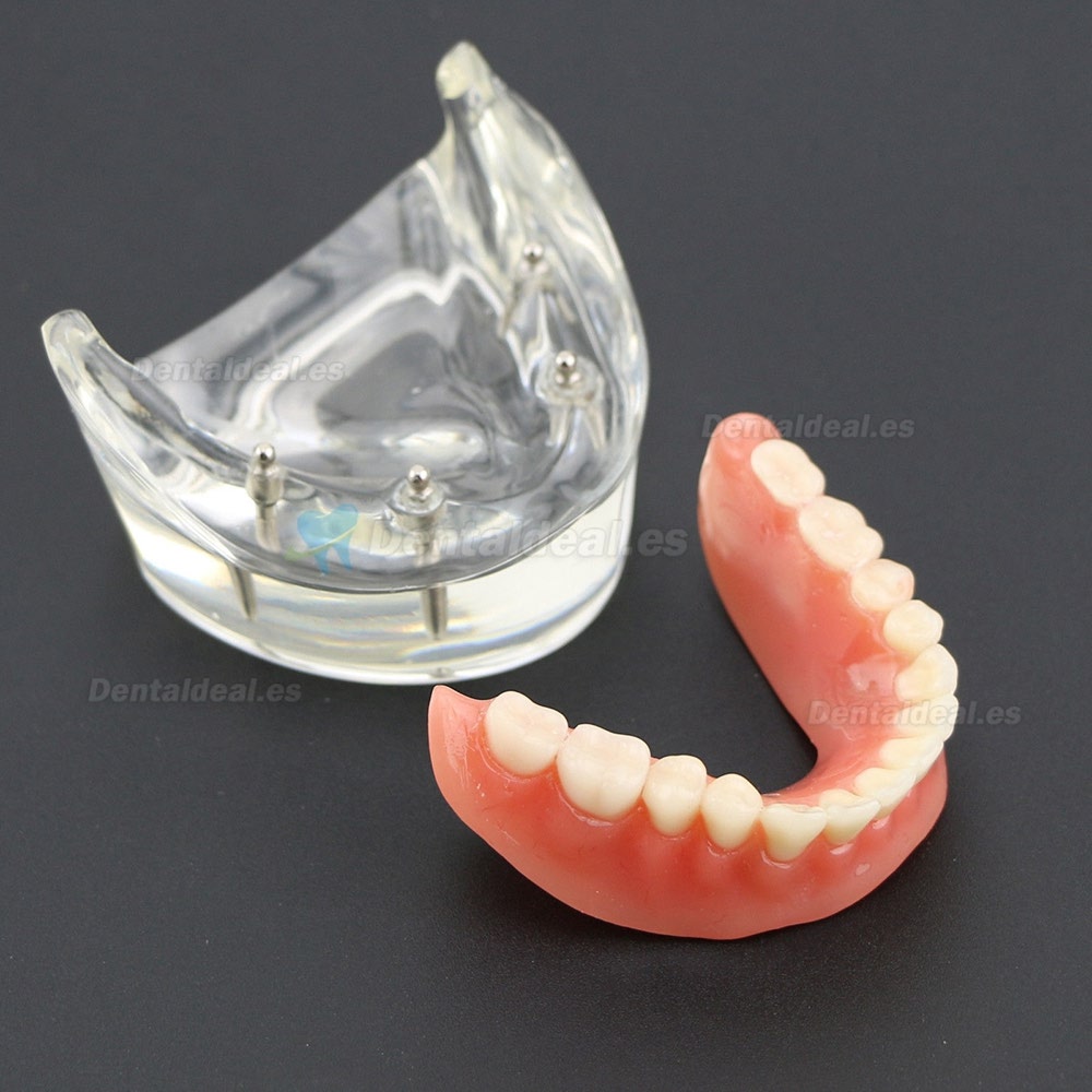 Dientes inferiores dental Modelo de sobredentadura 4 implantes Demostración Modelo 6002 02